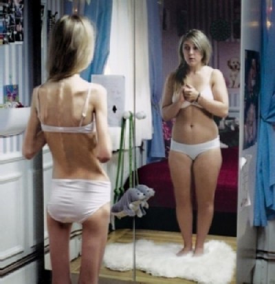 anoreksja